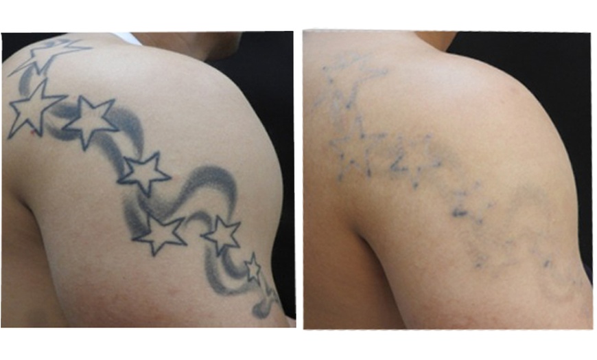 Image 2: Up to 71% Off on Tattoo Removal at Esteem Life Medical Group Limited