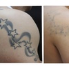 Image 2: Up to 71% Off on Tattoo Removal at Esteem Life Medical Group Limited