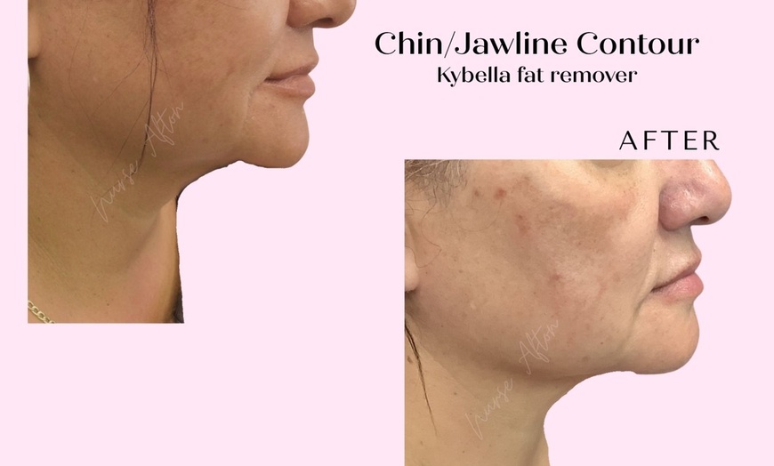 Image 4: ✨ Say Goodbye to the Double Chin with Kybella® ✨