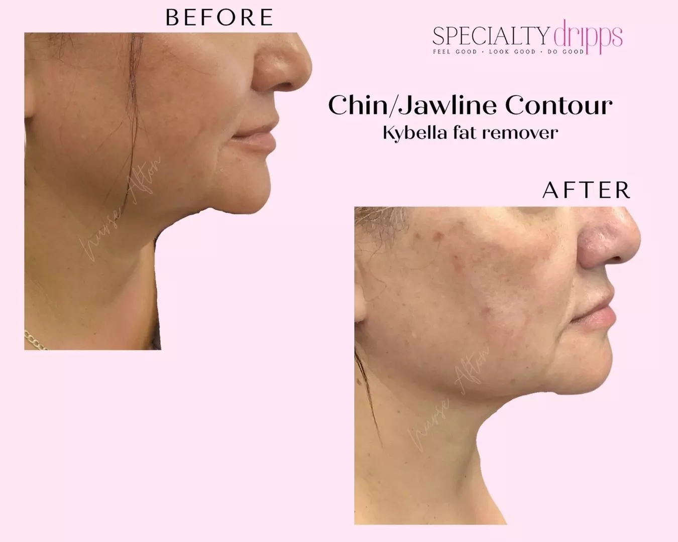 ✨ Say Goodbye to the Double Chin with Kybella® ✨