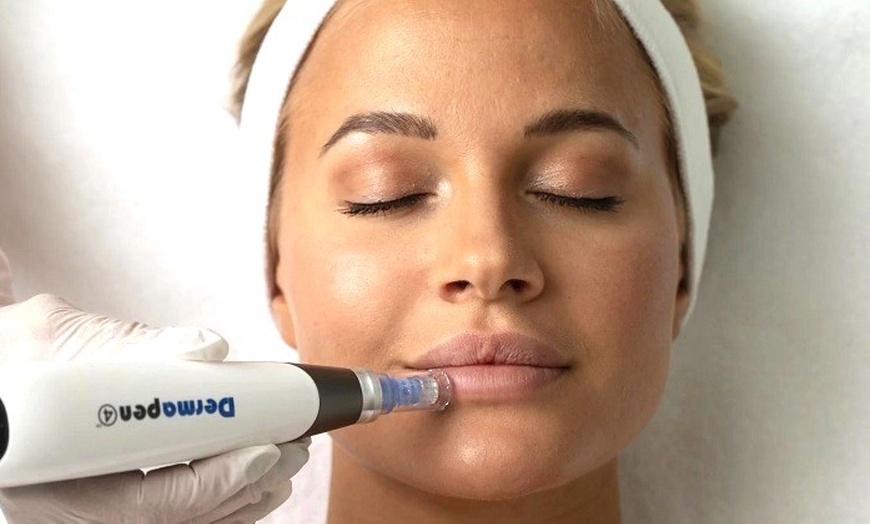 Image 1: 1, 2 o 3 sesiones de microneedling facial de vitaminas con Dermapen