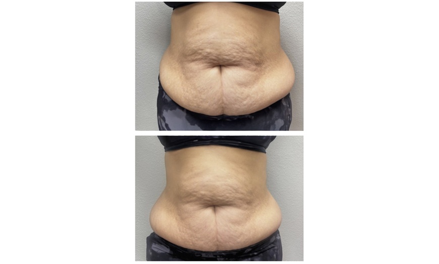 Image 2: 60- or 90-Min Body Contouring for One or Multiple Areas