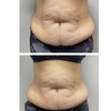 Image 2: 60- or 90-Min Body Contouring for One or Multiple Areas