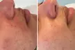 Microneedling-Behandlung  mit hochwertigen Cocktails oder Enzym-Lifting-Paket für 1 Person (50% sparen) - Second Medium