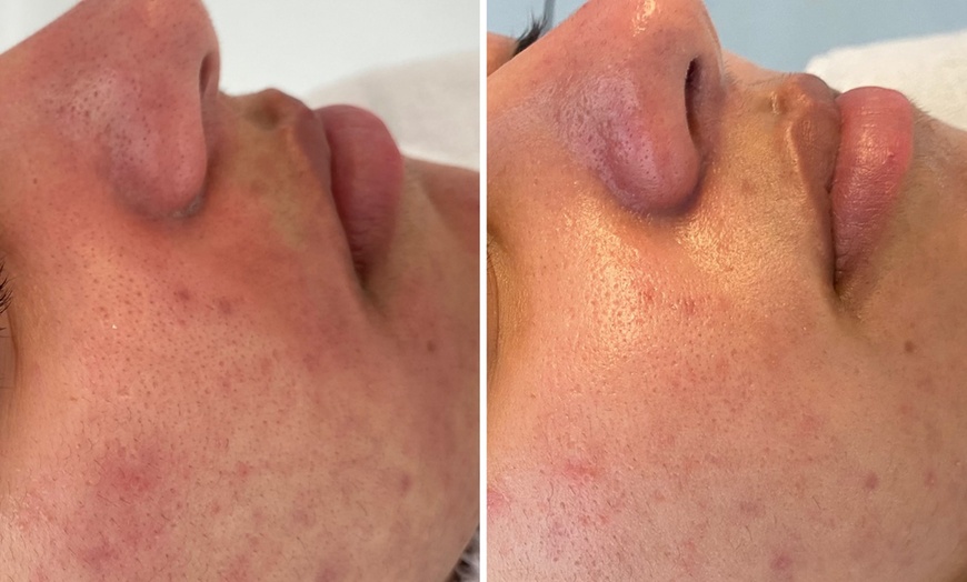 Image 6: Microneedling-Behandlung oder Enzym-Lifting-Paket für 1 Person