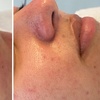 Image 6: Microneedling-Behandlung oder Enzym-Lifting-Paket für 1 Person