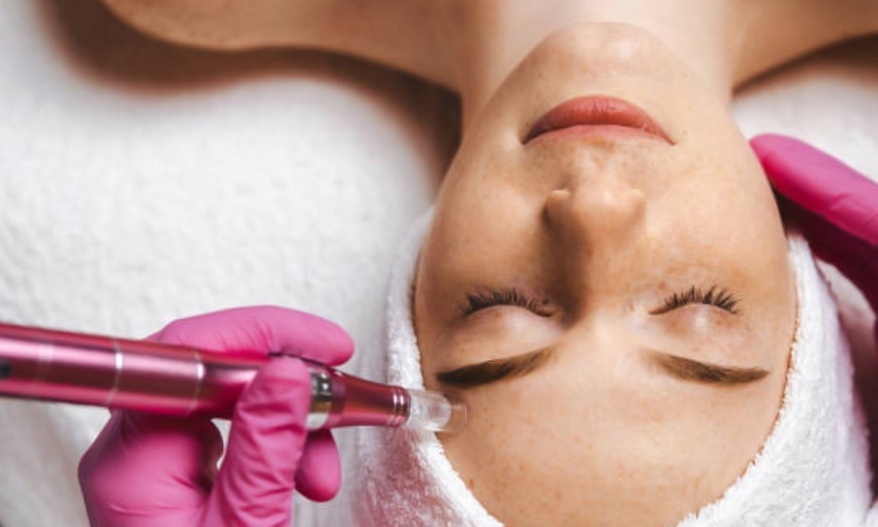 One, Two, or Three Sessions Of Micro needling Face & Neck