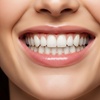 Image 4: Professional 1-Hour Teeth Whitening Session at Advanced Smile (save up to 67%)