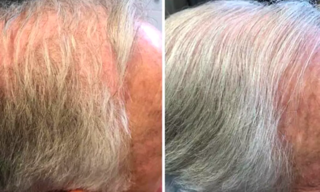 Personalized Hair  Regrowth Treatment for Thicker, Healthier Locks