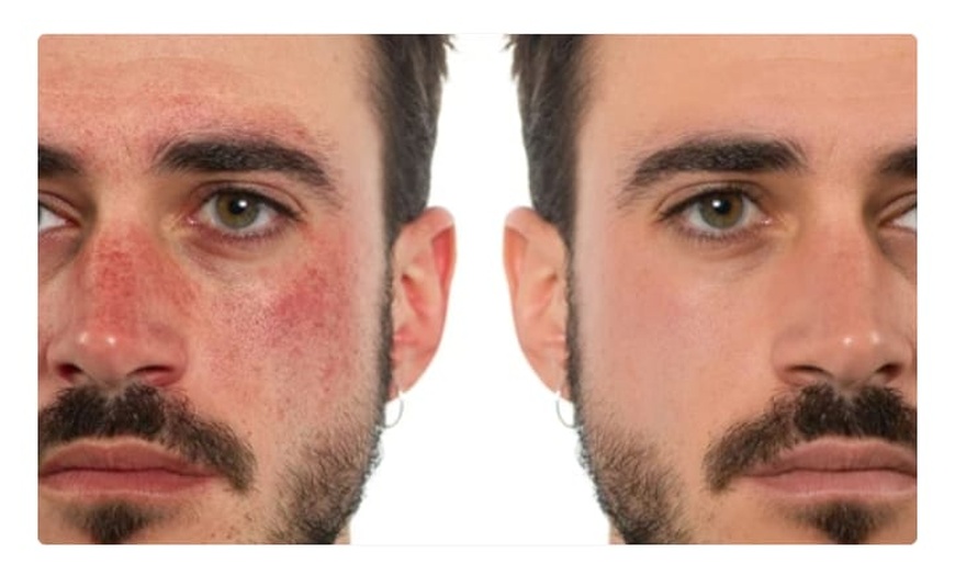 Image 4: CLEANESS ® Behandlungszentrum für Rosazea, Coupérose & Pigmentflecken