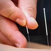 Image 1: Discover Healing with Acupuncture Treatment with Bodywork