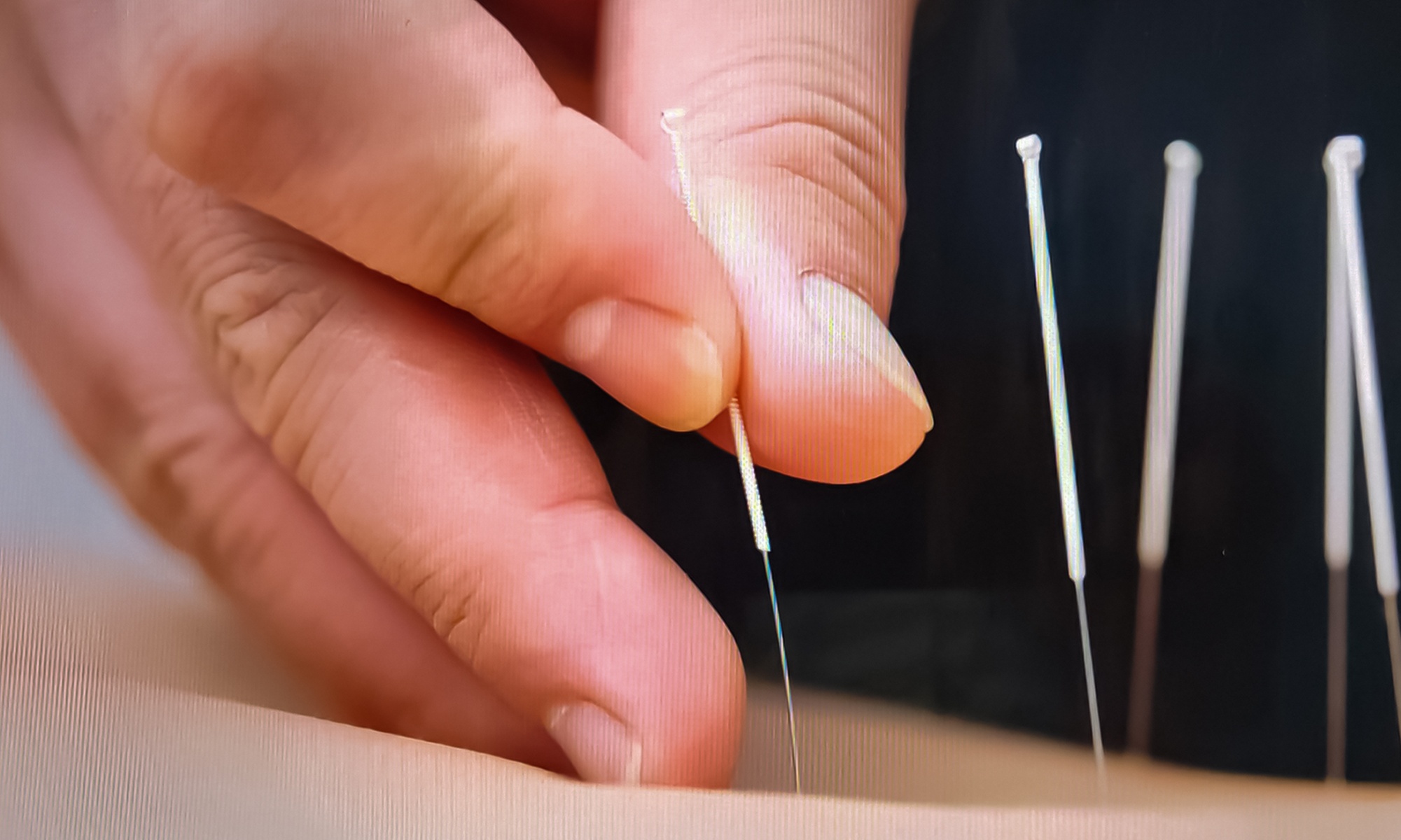 Discover Healing with Acupuncture Treatment with Bodywork