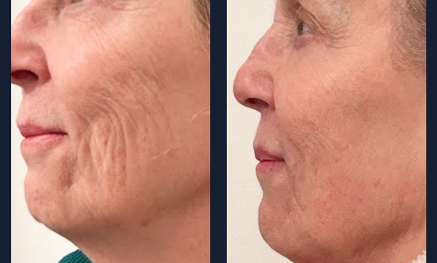 Image 8: Intro Cryo Slimming or 4 or 6 Cryo Contour Sessions