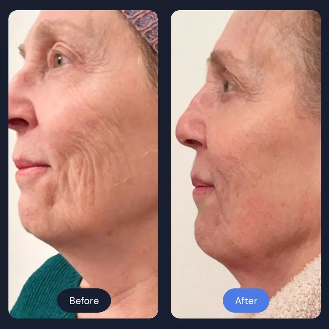 Intro Cryo Slimming or 4 or 6 Cryo Contour Sessions