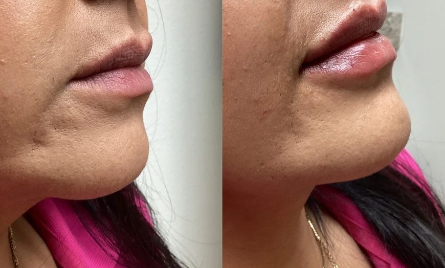 Image 2: Up to 30% Off on Injection - Dermal Filler at Soliz Healthcare Solutions