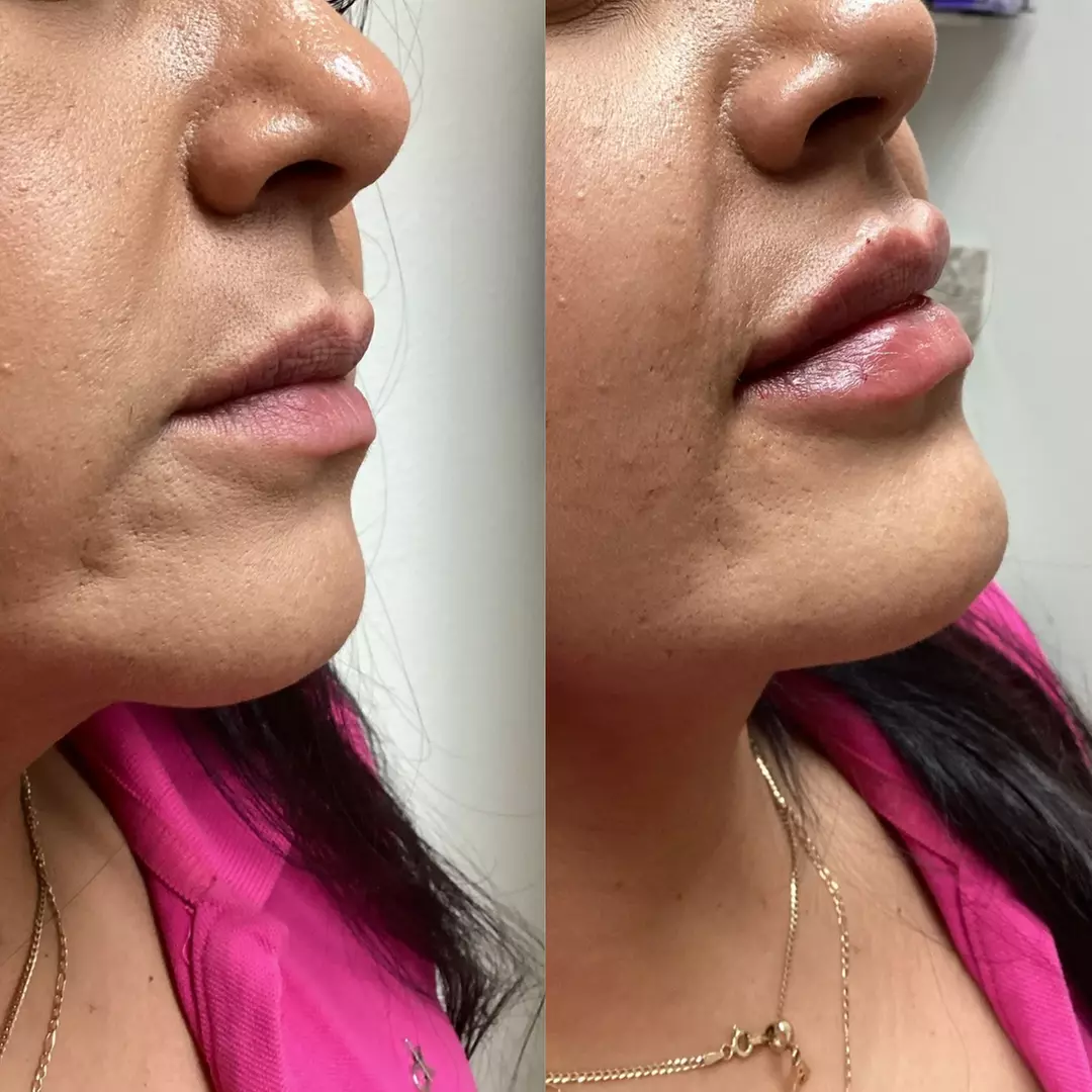 Up to 37% Off on Injection - Dermal Filler at Soliz Healthcare Solutions