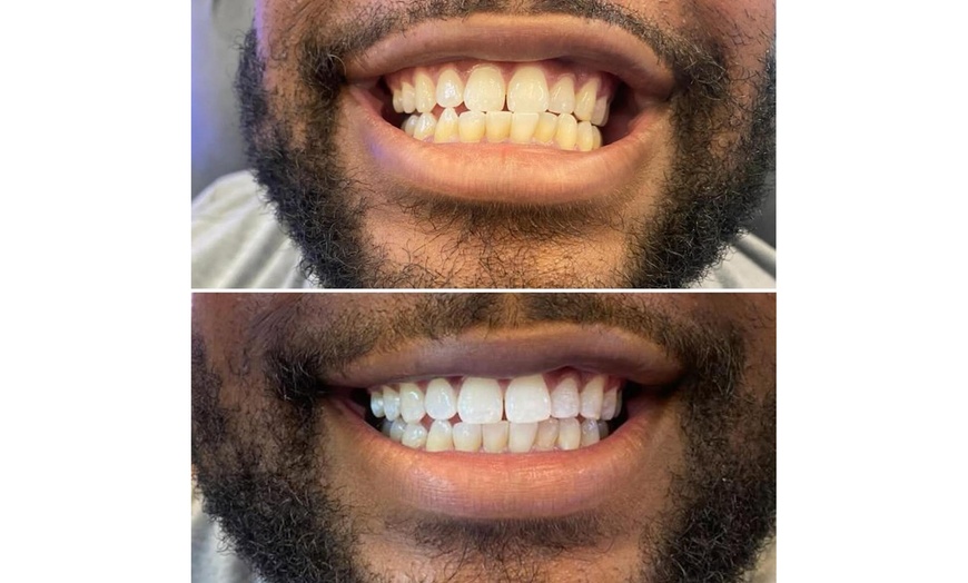 Image 7: Teeth Whitening with Carbamide Peroxide