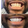 Image 1: Teeth Whitening with Carbamide Peroxide
