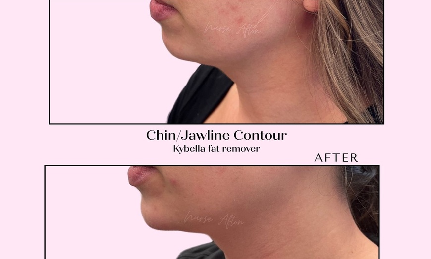Image 2: ✨ Say Goodbye to the Double Chin with Kybella® ✨