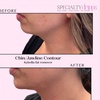 Image 2: ✨ Say Goodbye to the Double Chin with Kybella® ✨