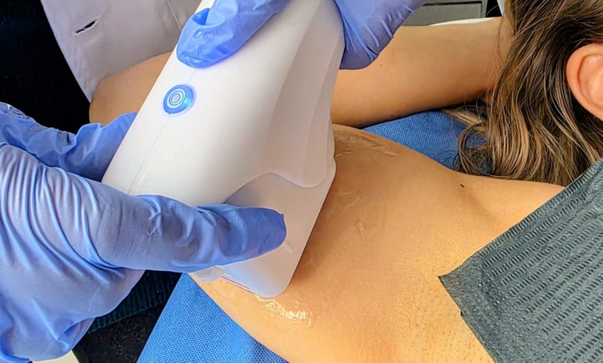 Image 3: One 12D HIFU Facelift  or Skin-Tightening Treatment