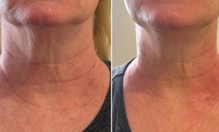 Image 4: Firmer, Youthful Skin with Radio Frequency Tightening for Face or Neck