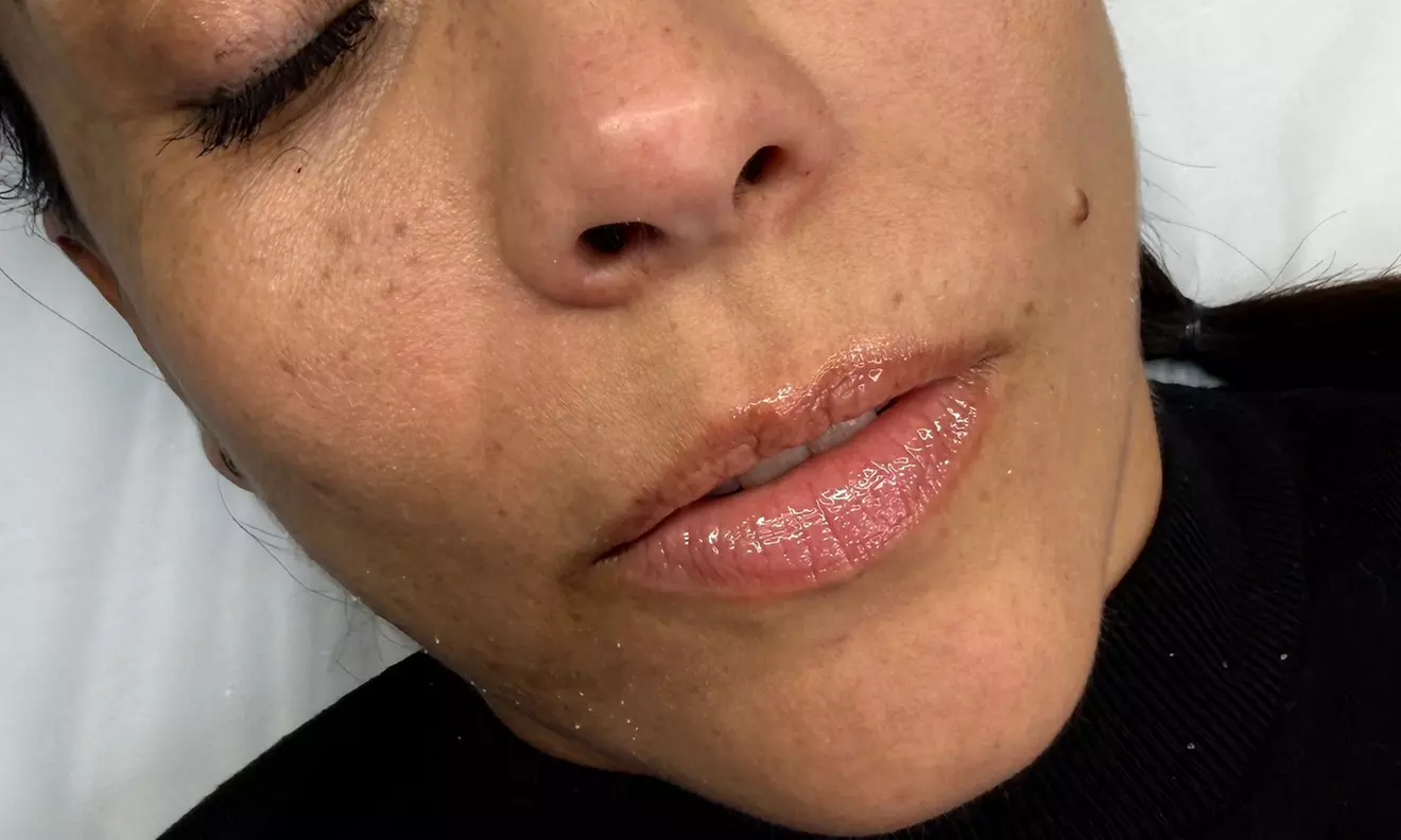 1 o 2 sesiones de rehidratación de labios con dermapen para 1 persona
