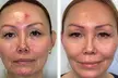 AdvaTx Laser in London Knightsbridge - Skin Rejuvenation For Pigmentation And More (Up to 41% Off) - Image 2