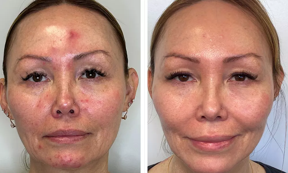 AdvaTx Laser Knightsbridge - Skin Rejuvenation For Pigmentation & More