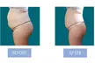Fat Buster or The Works – Body Consultation, Composition Analysis, & Skin Tightening Treatments (Up to 76% Off) - Second Medium