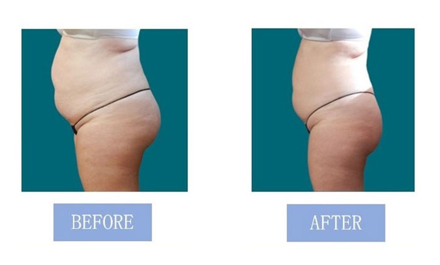 Image 7: Fat Buster or The Works – Body Consultation, Analysis, or More