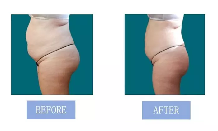 Fat Buster or The Works – Body Consultation, Analysis, or More