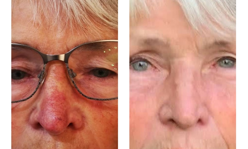 Image 1: CLEANESS ® Behandlungszentrum für Rosazea, Coupérose & Pigmentflecken