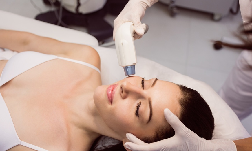 Image 1: 1 o 2 sesiones de radiofrecuencia facial con peeling químico