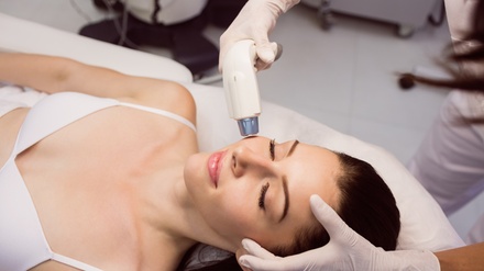 1 sesión de radiofrecuencia facial y peeling químico - Clínica G. Gónzález