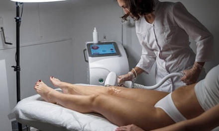 Depilación láser para 1 persona: 1 sesión / Zona pequeña - Emigrando Estetica