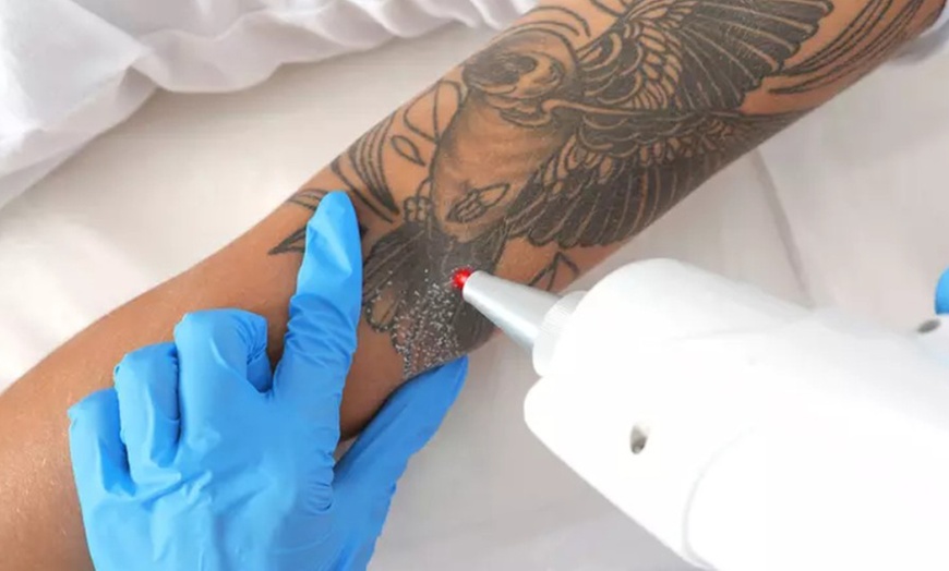 Image 1: 3 o 6 sesiones de eliminación de tatuajes con láser Q-Switched