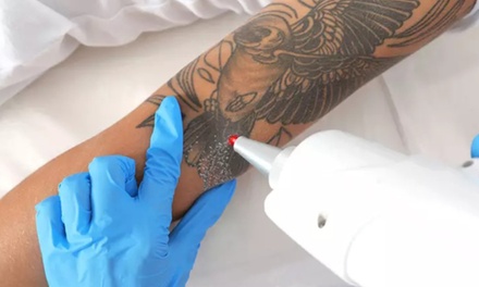 3 sesiones de eliminación de tatuajes con láser Q-Switched - Carla Rosell Body Care