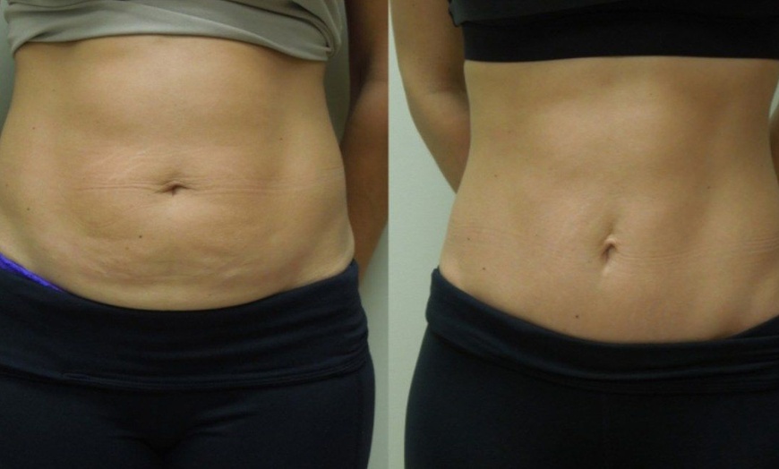 Image 2: Sculpt Your Body: Mesotherapy for Fat Reduction and Cellulite!