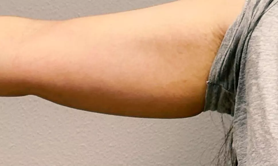 Sculpt w/ 1x, 3x or 5x Fat Dissolving Liquid Lipo Sessions -75 Minutes