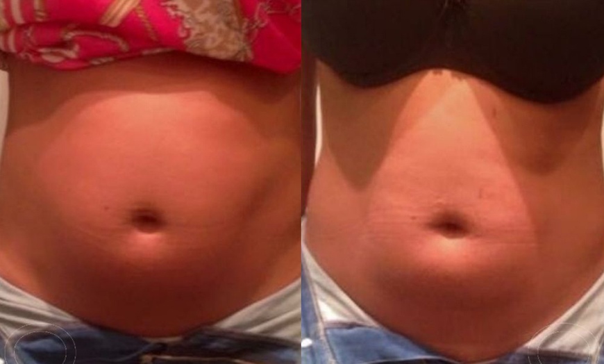 Image 3: Up to 73% Off on Ultrasonic Fat Reduction at LAMURE Aesthetic Clinic