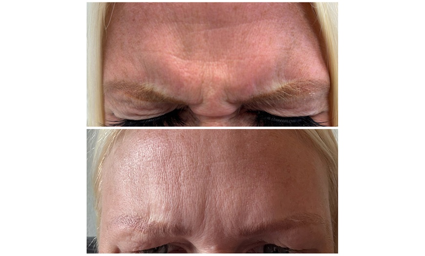 Image 9: Lip Flip or 20–40 Units of Xeomin for a Smooth, Youthful Look 