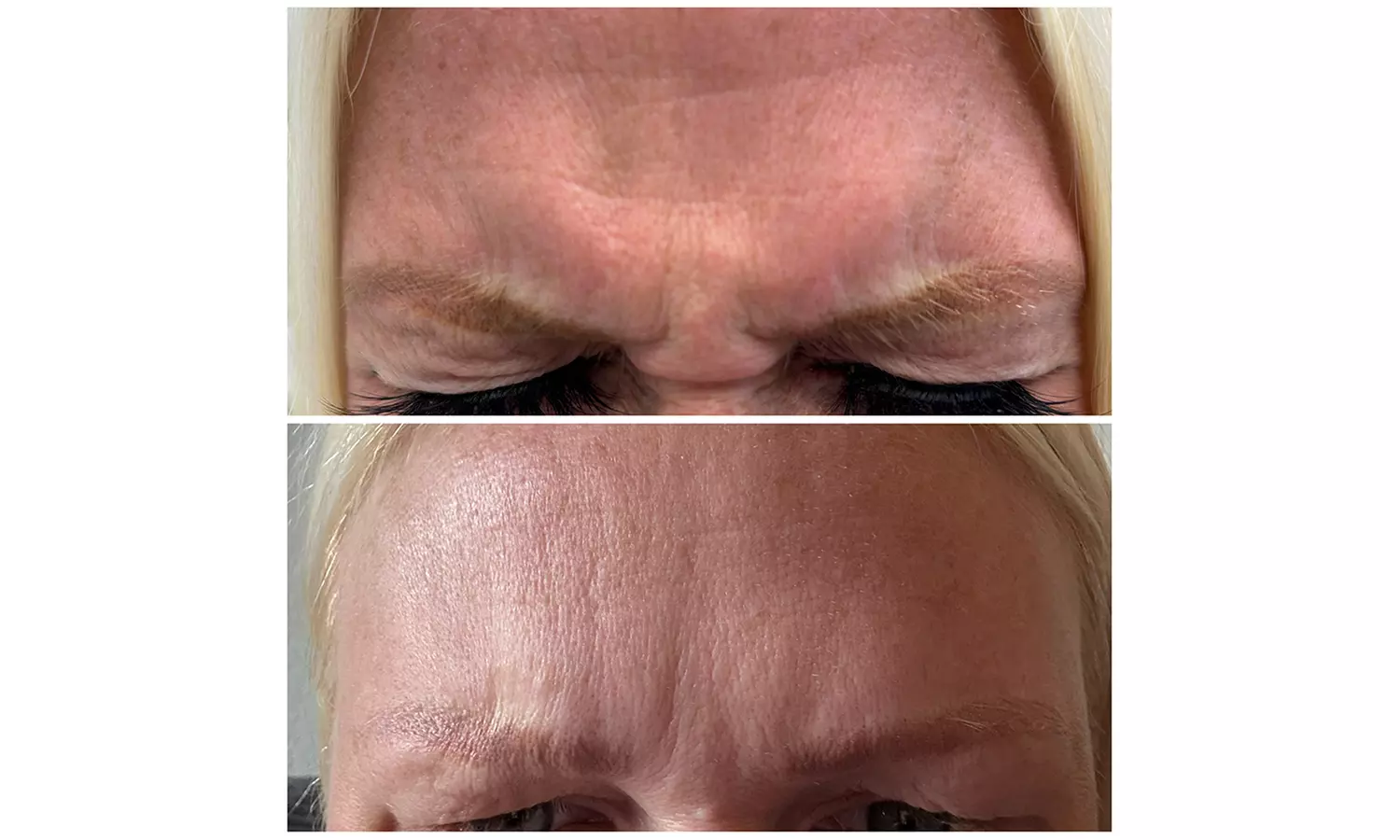 Lip Flip or 20–40 Units of Xeomin for a Smooth, Youthful Look