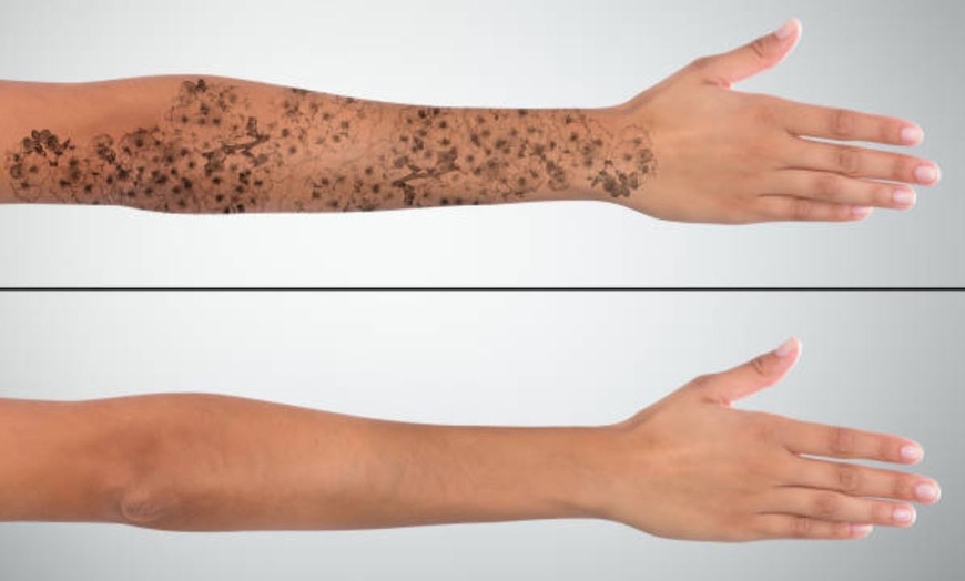 Image 12: 5 o 10 sesiones de eliminación de tatuajes