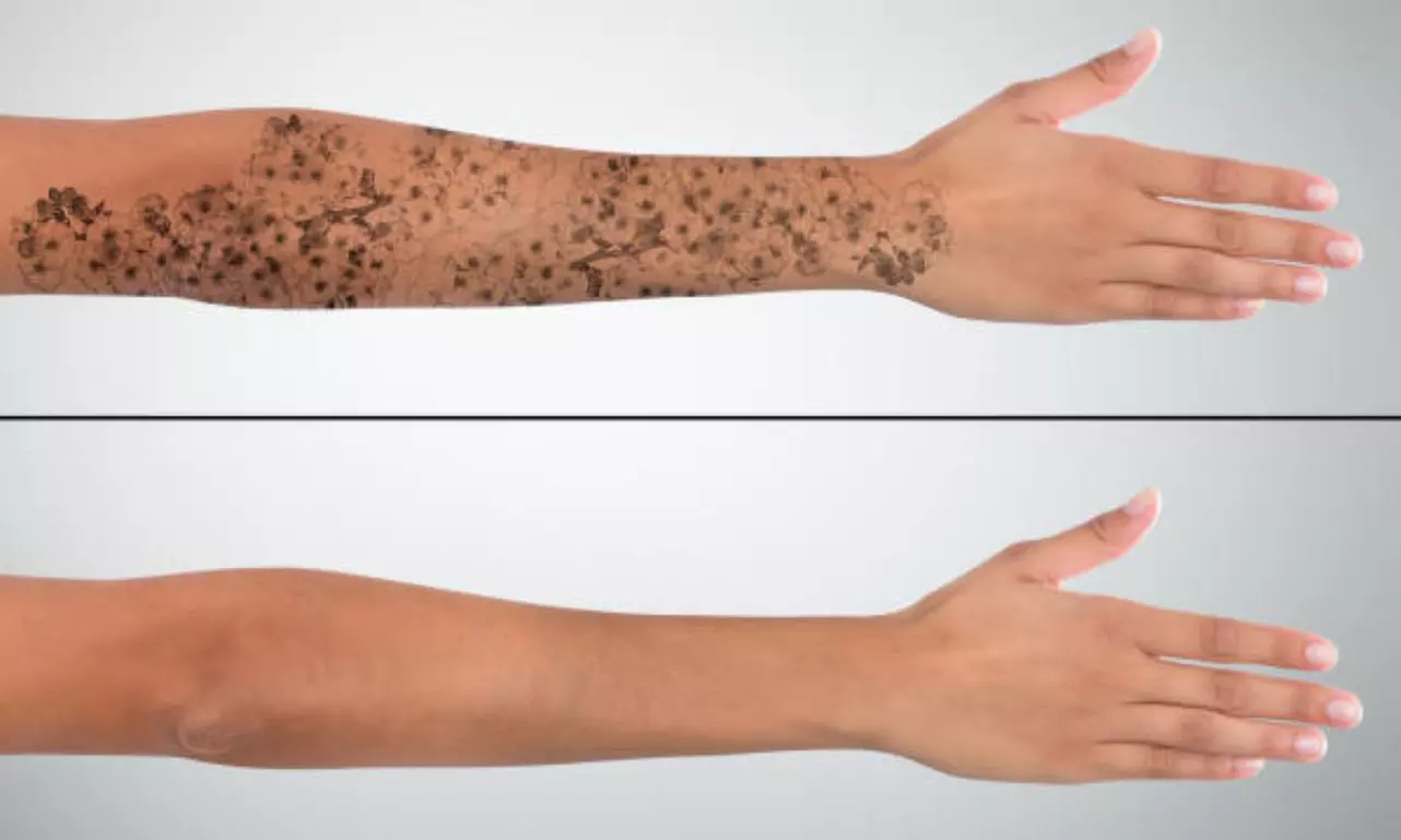 5 o 10 sesiones de eliminación de tatuajes