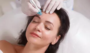 Microneedling, klassische oder Luxury-Anti-Aging-Gesichtsbehandlung für 1 Person (bis zu 46% sparen)