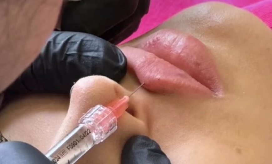 Image 2:  Juvederm + Botox —  40% Off at Beauty Factory SD