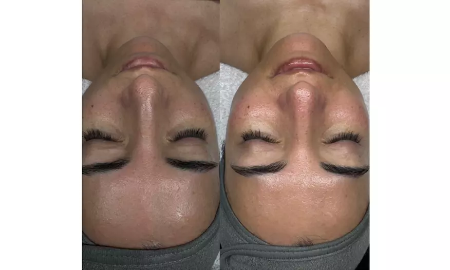 Rejuvenate Your Skin with Chemical Peel or Micro-Needling with Exosomes (Up to 66% Off) - Second Medium