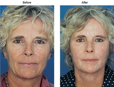 One Obagi Peel - Skin Care by Jani