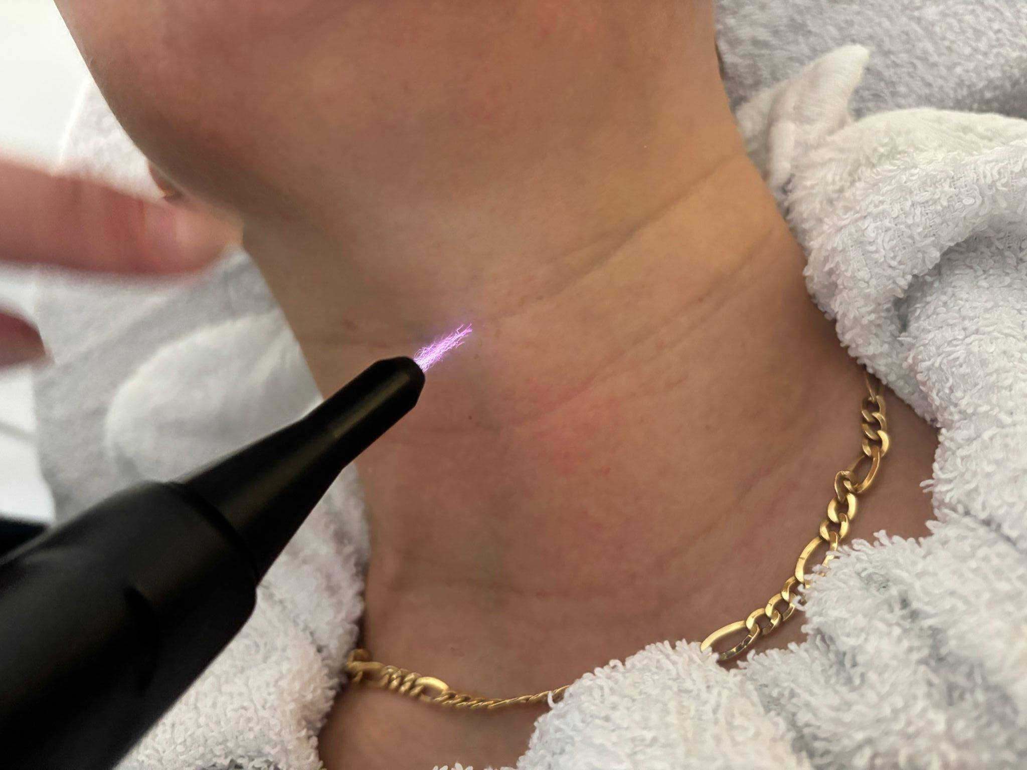 1 of 3 Fusion Cold Plasma-behandelingen op 1 of meerdere zones